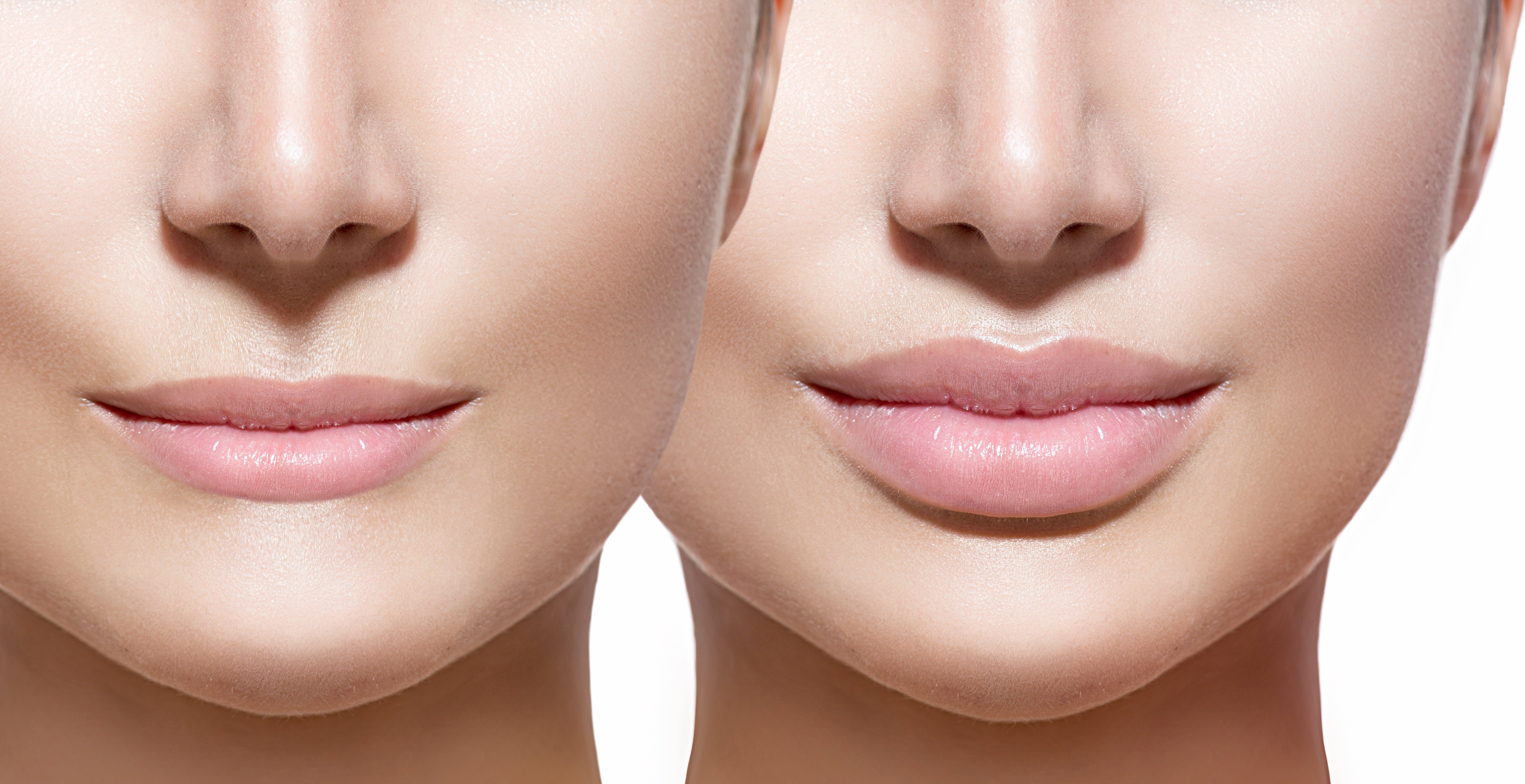 Lips filler treatment